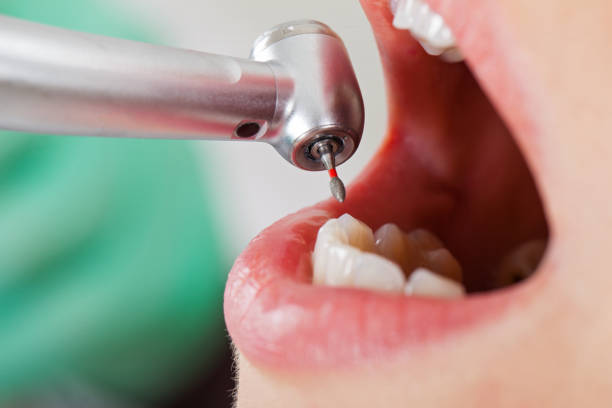Best Emergency Dentist for Lost Fillings or Crowns in St Peters, MO